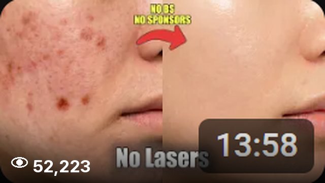 How I Faded My Acne Scars 52,223회